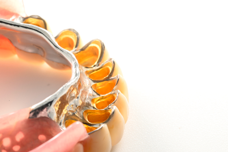 AGCテレスコープ義歯の利点