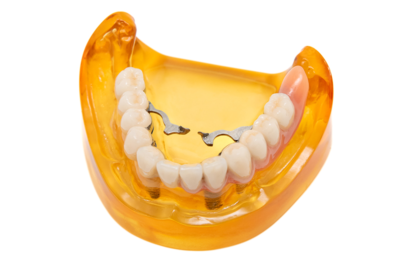 リーゲルテレスコープ義歯の利点