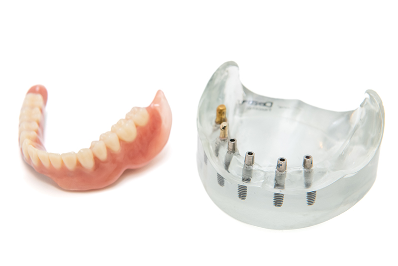 コーヌスクローネ義歯