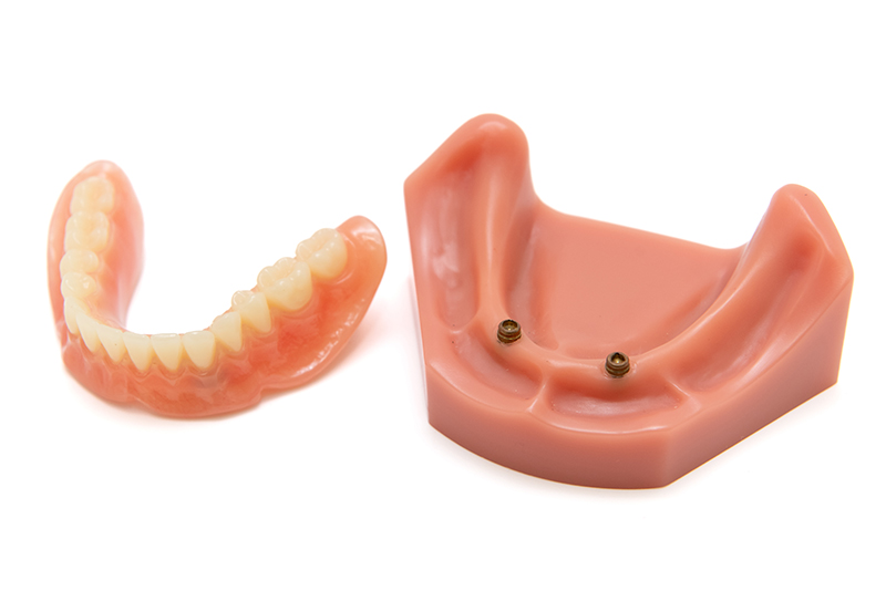 ロケーター義歯