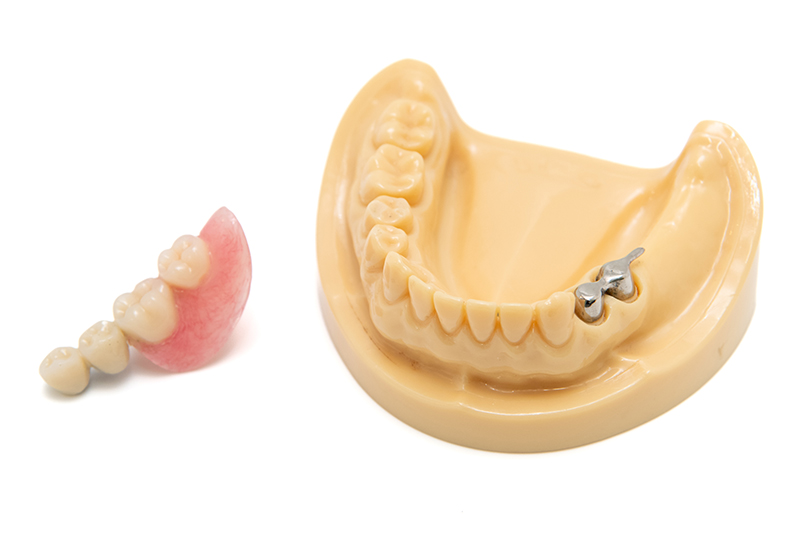 フリクションピン・コーヌステレスコープ義歯