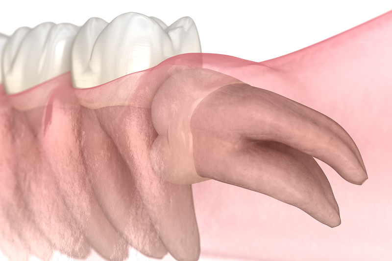 親知らずの抜歯について